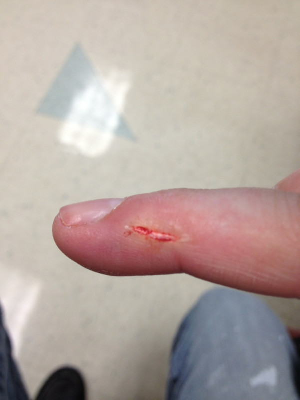 Finger injury