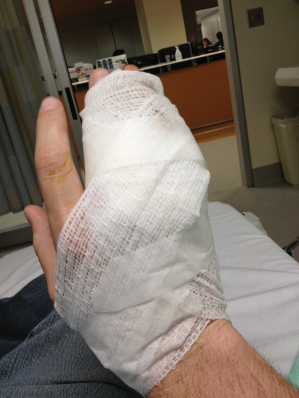 Post-surgery finger