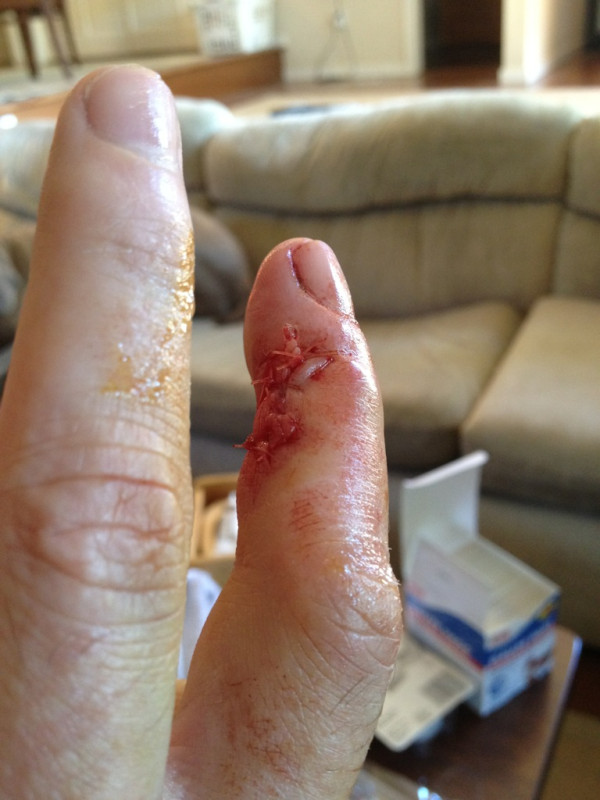 Day after the surgery